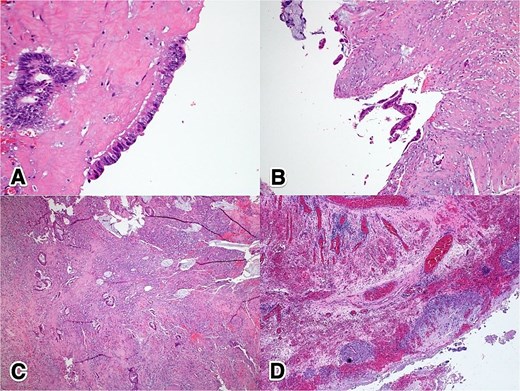 Histopathological features of ANs: (A) 40×, H&E—high-grade dysplastic epithelium at the appendiceal surface; (B) 20×, H&E—high-grade dysplastic epithelium at the appendiceal surface; (C) 4×, H&E—invasive adenocarcinoma penetrating the appendiceal wall; (D) 4×, H&E—acellular mucin with a surrounding granulomatous reaction at the serosal surface.