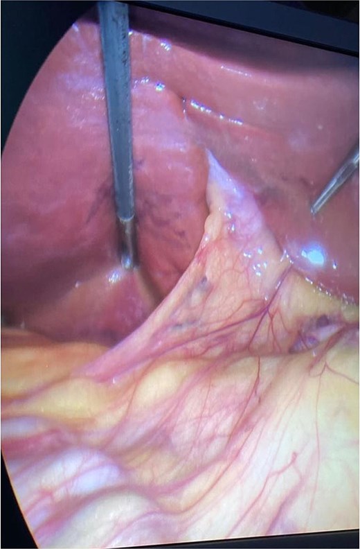 Intra-operative view showing the embedded gallbladder while utilizing diagnostic laparoscopy.