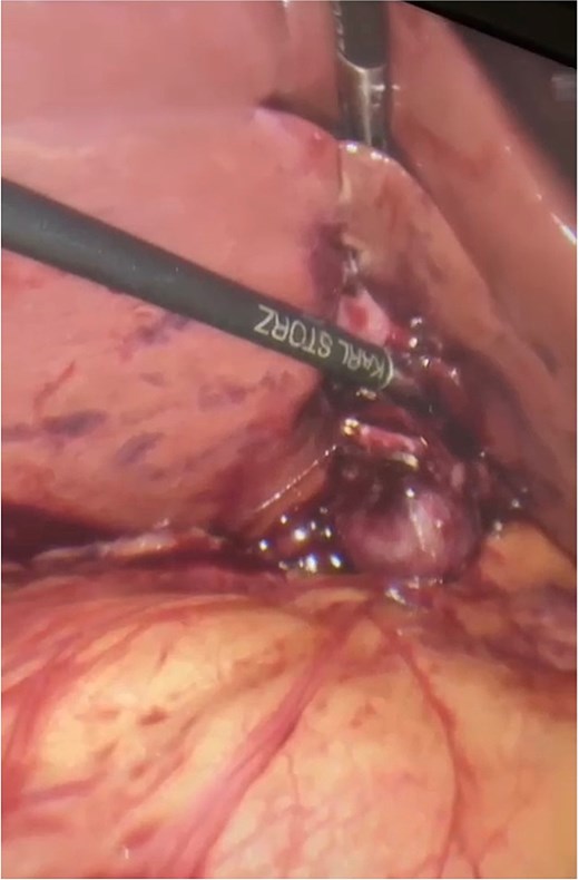 Intraoperative view showing the embedded gallbladder during dissection.