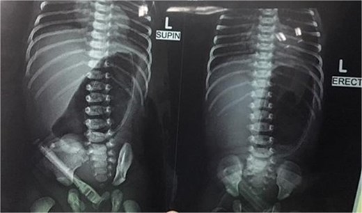 Plain abdominal X-ray showing gastric outlet obstruction.