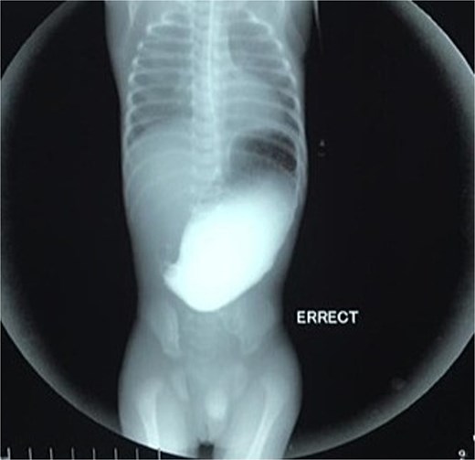 Upper gastrointestinal contrast study demonstrating pyloric obstruction.