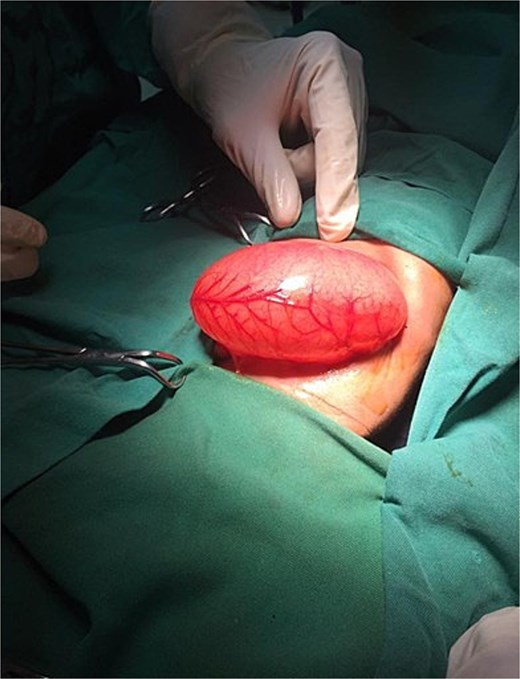 Intraoperative image showing a dilated stomach.