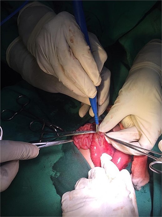 Intraoperative image showing pyloroplasty.