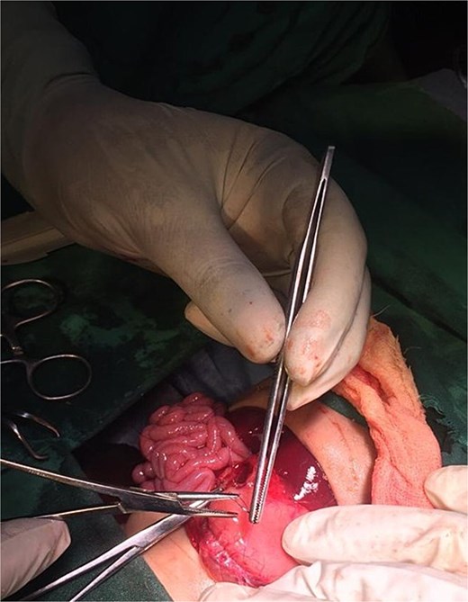 Postoperative image following pyloroplasty.