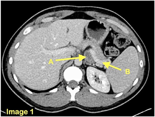 An axial CT scan view revealing the presence of a small bowel loop (A) behind the splenic vein (B).