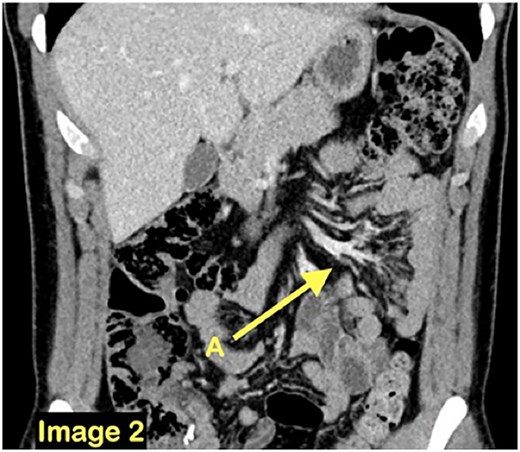 A coronal CT scan view demonstrating a cluster of small bowel loops (A) in the left abdomen.