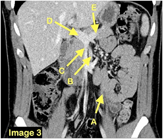 A coronal CT scan view demonstrating once again the clustered small bowel loops (A) and the surrounding vasculature inferior mesenteric vein (B), superior mesenteric vein (C), portal vein (D) and splenic vein (E).