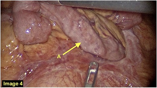 A laparoscopic view of the small bowel protruding through the hernia defect.