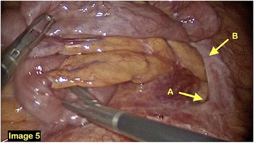 The fossa of Landzert is identified (A) alongside a fibrous band of tissue preventing the small bowel from moving freely through the fossa (B).