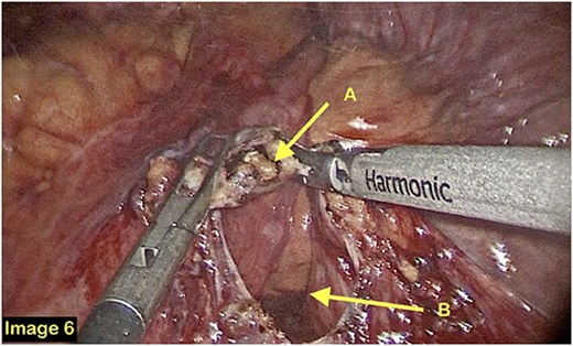 A laparoscopic view of the fibrous band being transected (A) and the fossa of Landzert (B).