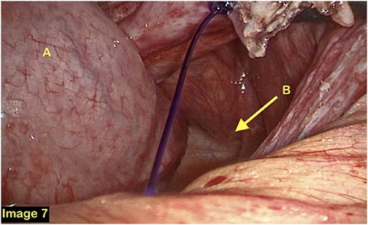 The duodenum (A) and the fossa of Landzert, widely opened (B).