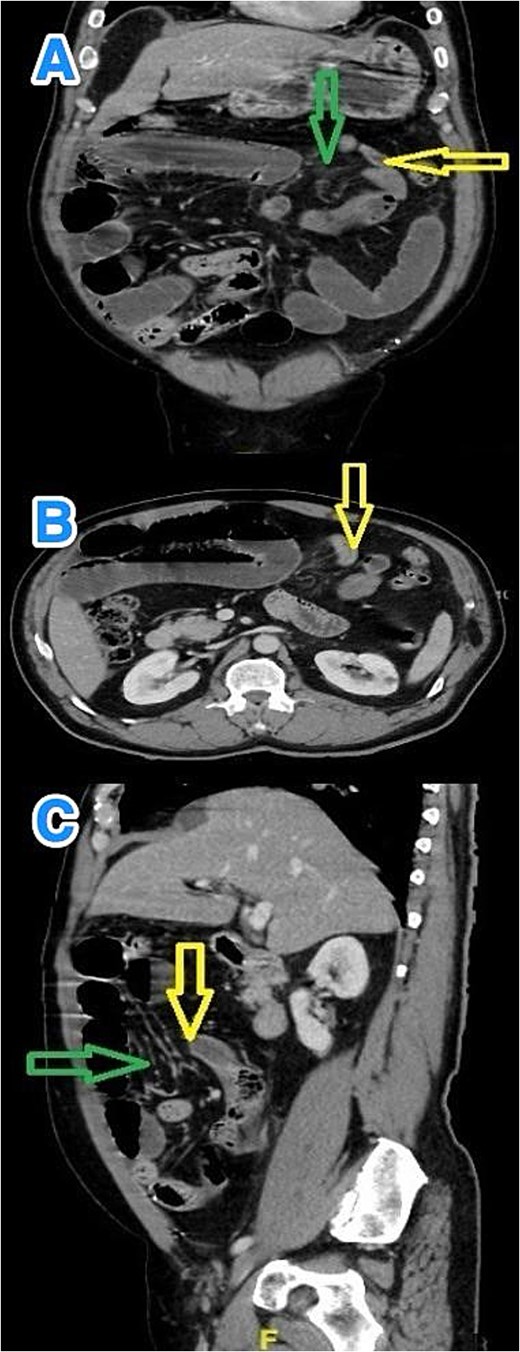 Multiview contrast-enhanced CT images of the abdomen demonstrate: (A) a coronal view showing herniated bowel (yellow arrow) through the greater omentum (green arrow), (B) an axial view showing the transition zone (yellow arrow), and (C) a sagittal view showing herniated bowel (yellow arrow) through the greater omentum (green arrow).
