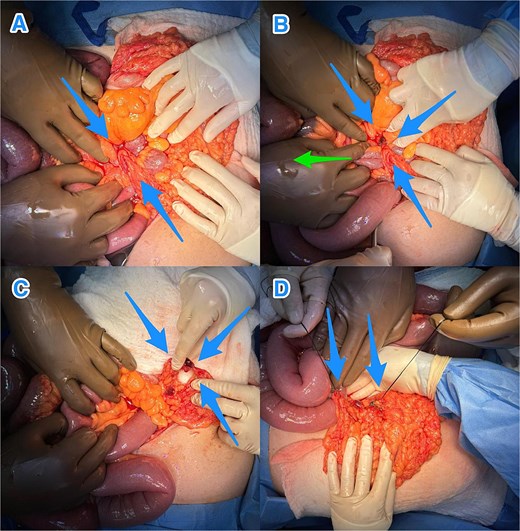Intraoperative views revealing: (A) a small bowel loop herniating through an omental defect of the greater omentum (blue arrows), (B) milking of the small bowel loops (green arrow) to reduce the herniated loop through the defect (blue arrows), (C) the transomental defect after reduction (blue arrows), and (D) the dividing omental defect (blue arrows).