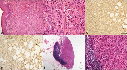 The pathological graphics of No. 2 patient with dermatofibrosaroma protuberans. (A) Spindle-shaped cells in a storiform pattern infiltrating the subdermal tissue (hematoxylin/eosin, original magnification ×100). (B) Original magnification ×400. (C) Positive staining for vimentin (original magnification ×200). (D) Positive staining for CD99 (original magnification ×200). (E) Metastasis of tumor cells in an inguinal lymph node. (hematoxylin/eosin, original magnification ×20). (F) Original magnification ×200.
