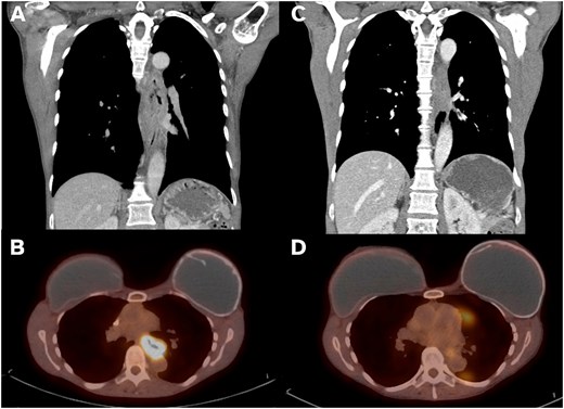 Imaging findings on presentation vs post-neoadjuvant therapy. (A) Coronal CT imaging showing 8.6-cm long esophageal mass. (B) PET imaging with mid-esophageal mass with SUV 15.4. (C) Post-CROSS protocol esophageal mass with significantly improved wall thickening on coronal CT. (D) Post-CROSS PET with decreased FDG avidity at the level of the mid esophagus.