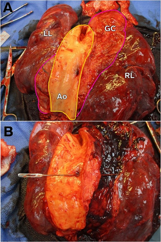 Gross autopsy images showing AEF. (A) Image of the intra-thoracic structures from the posterior-to-anterior view with the aorta opened. For orientation, the aorta is outlined in yellow and the gastric conduit outlined in pink. Note the ulceration on the aorta side of the AEF. LL, left lung. RL, right lung. GC, gastric conduit. Ao, aorta. (B) Probe traversing the AEF from the aorta into the gastric conduit, which is now opened, containing intra-luminal hemorrhage.