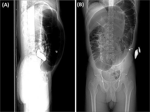 (A) The preliminary view on abdominal CT (scout view) revealed a distended sigmoid loop exhibiting an inverted U-shape, commonly recognized as the coffee bean sign. (B) The preliminary view on abdominal CT (scout view) showed dilated bowel loops.