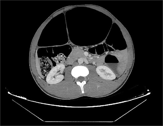 Axial abdominal CT scan revealed dilated gas-filled loops with lack of the haustration.