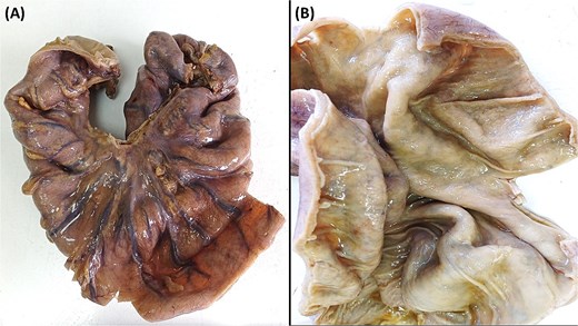 (A) The sigmoid colon, upon gross examination measured 30 cm in length with a maximum diameter of 10 cm. (B) Upon dissection, the colonic mucosa appeared flattened, revealing hemorrhagic spots, signs of vascular congestion, and evident edema.