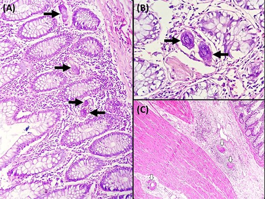 (A) Ovoidal schistosoma eggs surrounded by a polymorphous inflammatory infiltrate (black arrow), (Hematoxylin and eosin, magnification × 200). (B) Microscopic examination reveals Schistosoma eggs which are elongate (Hematoxylin and eosin, magnification × 400). (C) Microscopic analysis of the sigmoid colon revealed the presence of multiple foreign body granulomas within the submucosa and muscular layer (white arrows) (Hematoxylin and eosin, magnification × 100).