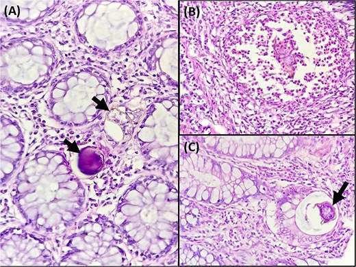 (A) Microscopic analysis of the sigmoid colon revealed calcified schistosomal eggs in the mucosa (black arrow) (Hematoxylin and eosin, magnification ×400). (B) Microscopic examination revealed a polymorphous inflammatory infiltrate with numerous eosinophils surrounding a schistosoma egg (Hematoxylin and eosin, magnification ×400). (C) Microscopic analysis of the sigmoid colon revealed ovoidal schistosoma egg within the crypt lumen (black arrow) (Hematoxylin and eosin, magnification × 400).
