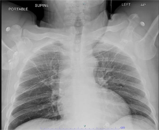 Initial chest X-ray demonstrating bilateral luxatio erecta.