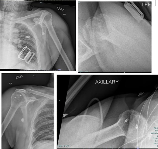 Post-reduction X-rays demonstrating congruency restored to right and left glenohumeral joints, with evidence of superior humeral head migration bilaterally.