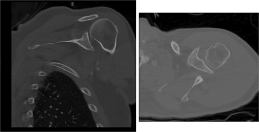 Post-reduction CT of the left shoulder demonstrating superior humeral head migration relative to the glenoid.