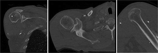 Post-reduction CT of the right shoulder demonstrating superior humeral head migration relative to the glenoid, visualized evidence of prior rotator cuff repair surgery, and a nondisplaced anterior-inferior glenoid fracture.