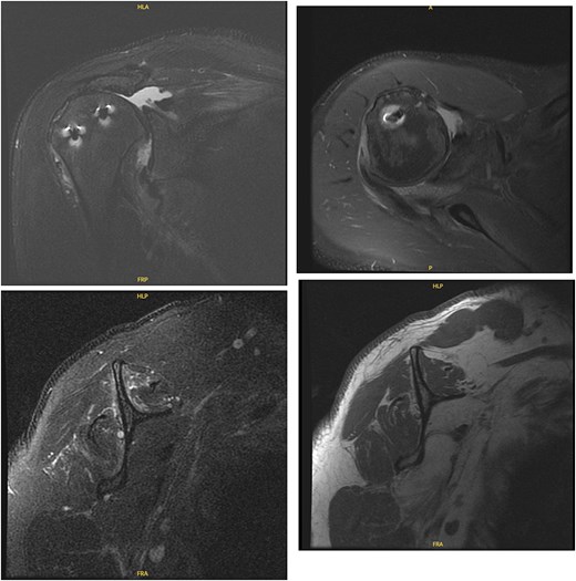 MRI of the right shoulder demonstrating full-thickness tearing of the supraspinatus and infraspinatus with medial tendon retraction, a high riding humeral head, intermediate grade partial thickness tear of the teres minor, severe fatty atrophy of the subscapularis muscle belly, labral degeneration, and tearing, partial thickness tearing of the inferior glenohumeral ligament, anterior-inferior glenoid subchondral marrow edema, and severe glenohumeral cartilage abnormalities.