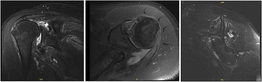 MRI of the left shoulder demonstrating a full-thickness tear of the supraspinatus and infraspinatus with tendon retraction, high grade partial thickness tearing of the subscapularis, full-thickness tear of the biceps long head tendon, complex anterior labrum tear, partial thickness tear of the inferior glenohumeral ligament including the anterior and posterior bands, inferior glenoid subchondral marrow edema, and moderate glenohumeral degenerative changes.