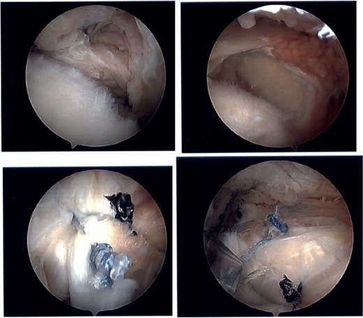 Intraoperative imaging of left shoulder arthroscopic debridement and rotator cuff repair including findings of full-thickness supraspinatus and subscapularis tendon tears, which subsequently were repaired.