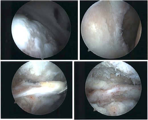 Intraoperative imaging of right shoulder arthroscopic debridement including findings of full-thickness supraspinatus and subscapularis tendon tears, which subsequently were not able to be repaired, as well as significant glenohumeral degenerative change.