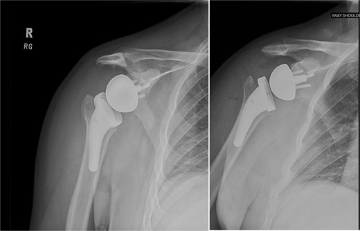 Right reverse total shoulder arthroplasty at 3-month postoperative follow-up.