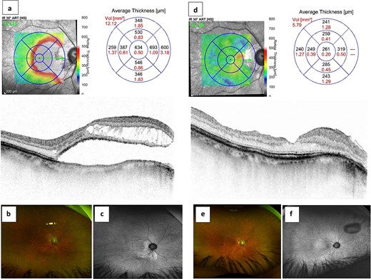 Efficiency of pars plana vitrectomy associated with inverted internal limiting membrane flap technique for optic disc pit maculopathy. The preoperative optical coherence tomography (a) and ultra-widefield scanning laser ophthalmoscopy (b and c) revealed intraretinal and subretinal fluid associated with a macular detachment of central foveal thickness (CFT) of 634 μm in the right eye. The improvement of CFT of 261 μm (d) with complete resolution of intraretinal and subretinal fluid (e and f) after surgery.