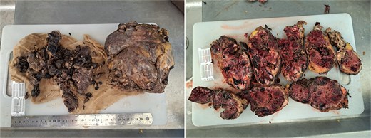 Gross appearance of the resected hepatic mass showing a large, multilobulated tumor with irregular contours. The cut surface reveals heterogeneous areas of hemorrhage, necrosis, cystic degeneration, and solid tumor tissue, features characteristic of UESL. The overall morphology reflects the high-grade and aggressive nature of the neoplasm.