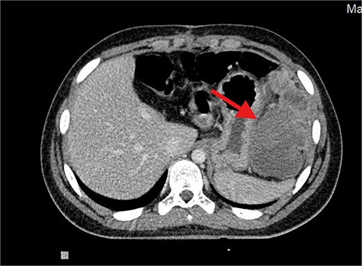 Contrast-enhanced axial CT image showing a large, heterogeneously enhancing soft tissue mass measuring ⁓11 × 5.5 × 8.3 cm in the left subphrenic region, abutting, and indenting the greater curvature of the stomach. The lesion demonstrates internal cystic and necrotic components, consistent with a recurrent undifferentiated embryonal sarcoma.