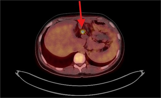 PET/CT scan shows a clear surgical site (left subphrenic area) with no residual/recurrent mass, but there are multiple peritoneal and mesenteric nodules which appear to be hypermetabolic on PET scan, suggesting secondary metastasis.