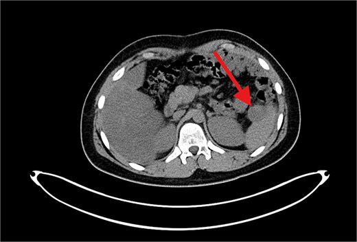 PET/CT scan showing a clear surgical bed. Almost complete metabolic resolution of the previous hypermetabolic abdominal deposits. Development of focal hypermetabolic activity just anterior and abutting the lower spleen pole, at the projection of splenic flexure of the descending colon, this lesion is nonspecific.