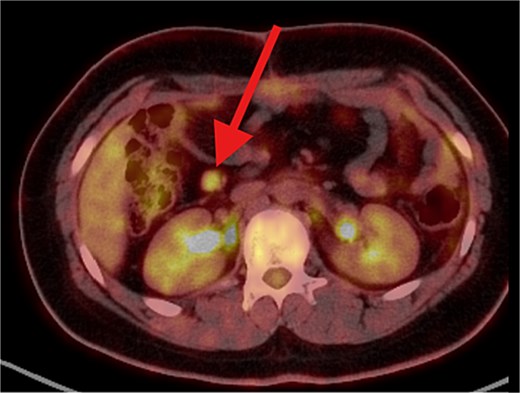 PET/CT scan showing a clear surgical bed. There is heterogeneous mostly cystic lesion at splenic surgical bed with moderate FDG uptake at its peripheral soft tissue component, mostly post-surgical sequel. Interval development of right abdominal para median soft tissue / mesenteric nodule with moderate hypermetabolic activity. Suspicious for metastatic process.