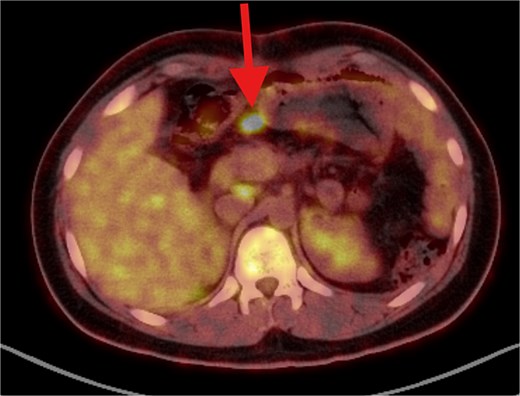 PET/CT scan demonstrating the following findings: (1) Clear splenic surgical bed with regression in size and metabolic activity of the previously noted lesion, consistent with resolved post-surgical sequelae. (2) Complete metabolic resolution of the previously identified hypermetabolic right para-median/mesenteric nodule. (3) Development of a new hypermetabolic mid-abdominal mesenteric nodule measuring ⁓2 × 1.5 cm, raising concern for potential disease recurrence.