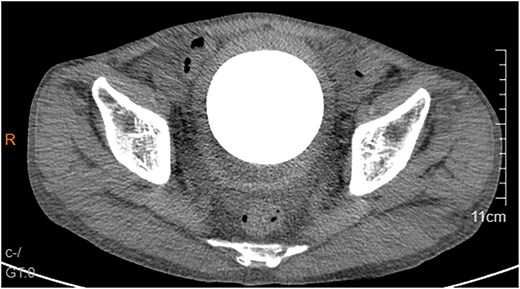 Abdominal CT showed a massive bladder stone measuring 76 × 74 mm, thickened bladder walls.