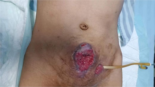 On examination, there was excessive granulation tissue proliferation around the bladder incision wound and near the bladder diversion tube, with surface exudation and easy bleeding on touch.