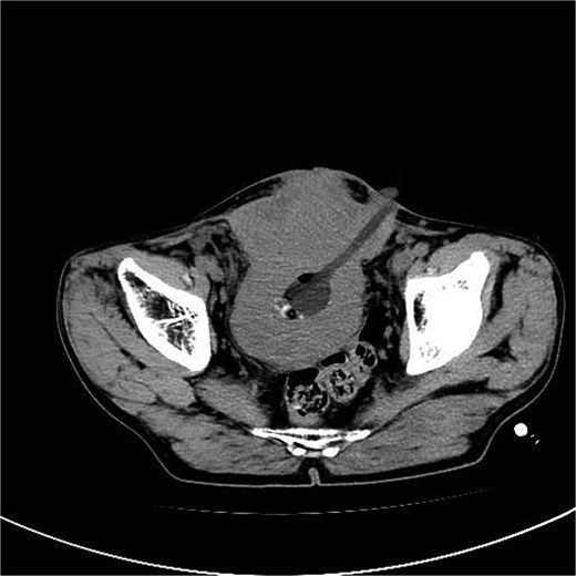 Abdominal CT and pelvic MRI revealed bladder wall thickening and soft tissue in the anterior pelvic area.