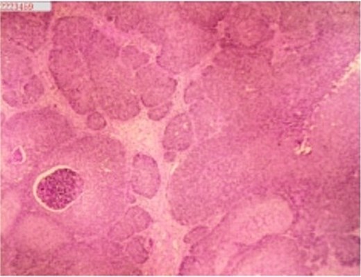 Histopathology of abdominal wall tumor: moderately differentiated squamous cell carcinoma. Immunohistochemistry (10 × 10):CK(pan)(+),CK20(−), CK7(−), PAX-8(−), GATA3(−), P63(+), P53(+), Ki-67(+) at 40%.