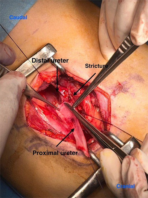 Intraoperative image showing a proximal ureteric stricture.
