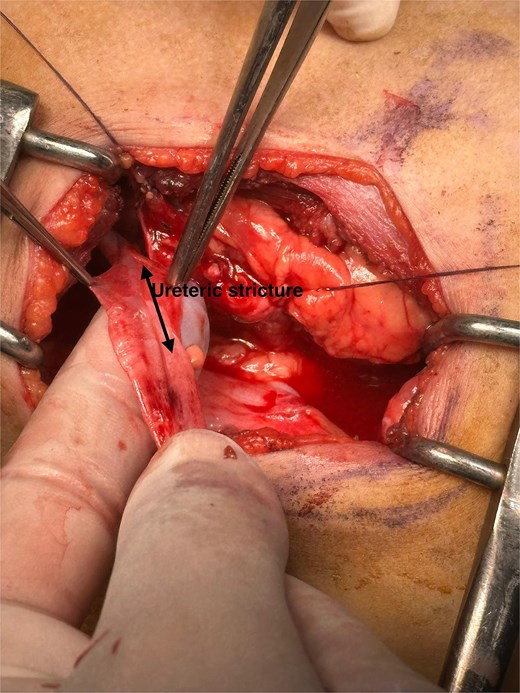 Intraoperative imaging shows a non-probe-patent mechanical obstruction of the proximal ureter, measuring 2 cm in length and located 4 cm below the ureteropelvic junction.