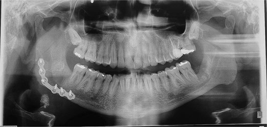 Lesion capsule and sectioned tooth