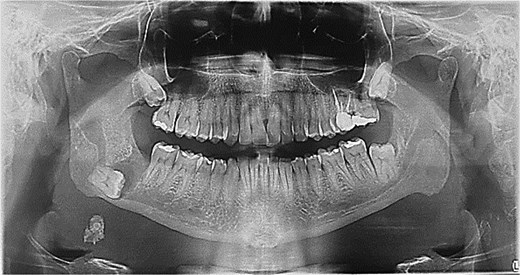 Bone plate 2.4 mm adapted.
