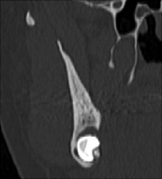 Four months post-operative orthopantomography.